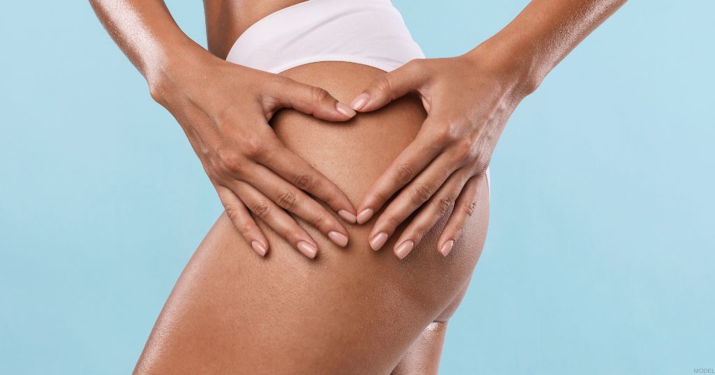 Woman after a brazilian butt lift. (Model)