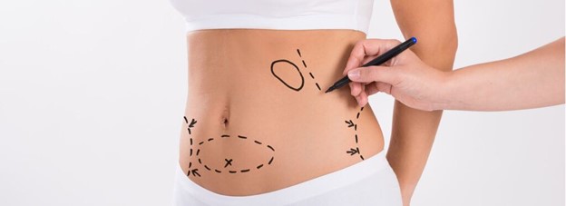 Woman preparing to receive mommy makeover surgery (model)