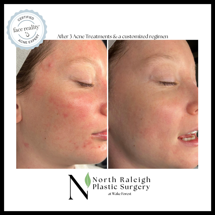 After 3 acne treatments and a customized regimen