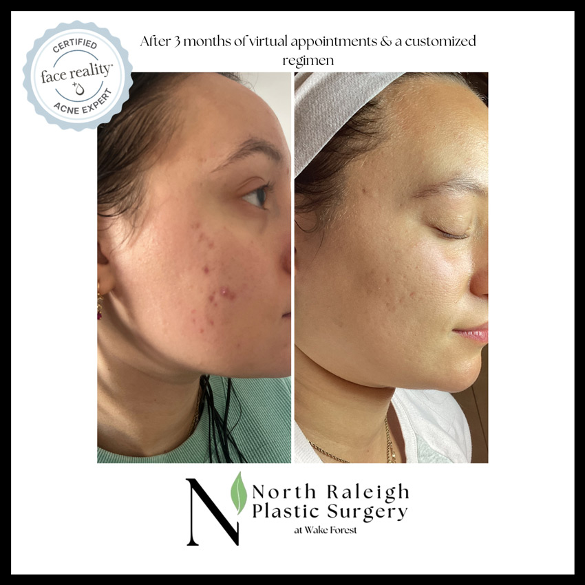 After 3 months of virtual appointments and a customized regimen