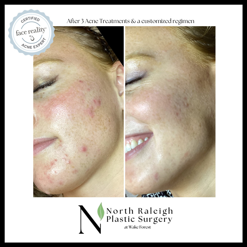 After 3 acne treatments and a customized regimen