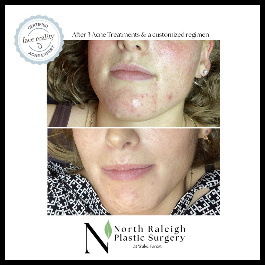 After 3 acne treatments and a customized regimen