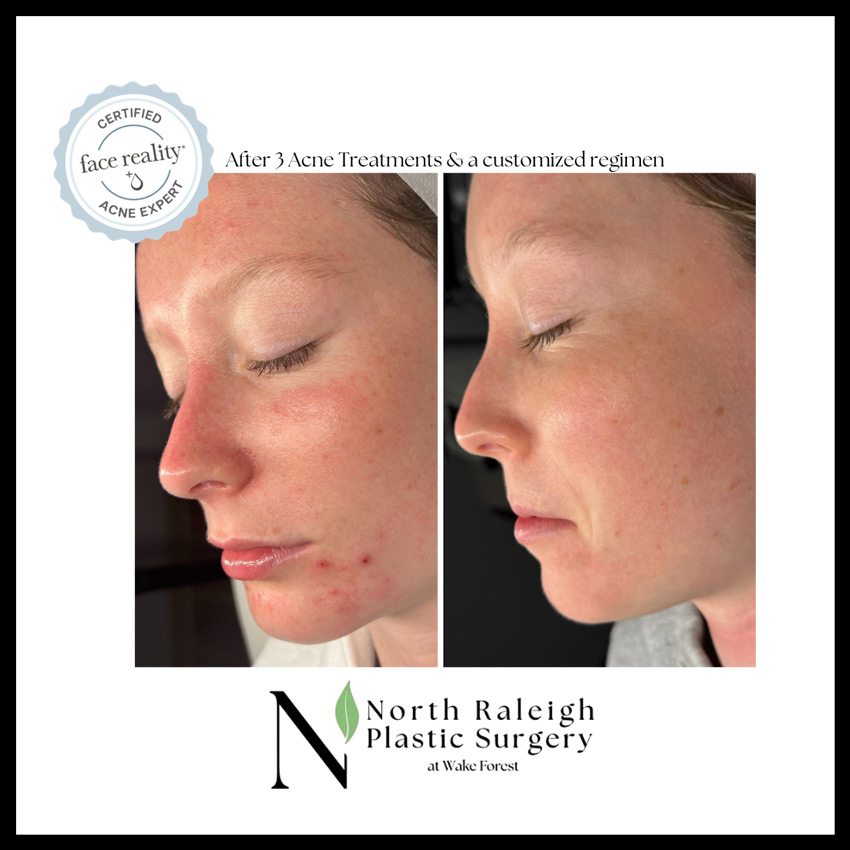After 3 acne treatments and a customized regimen