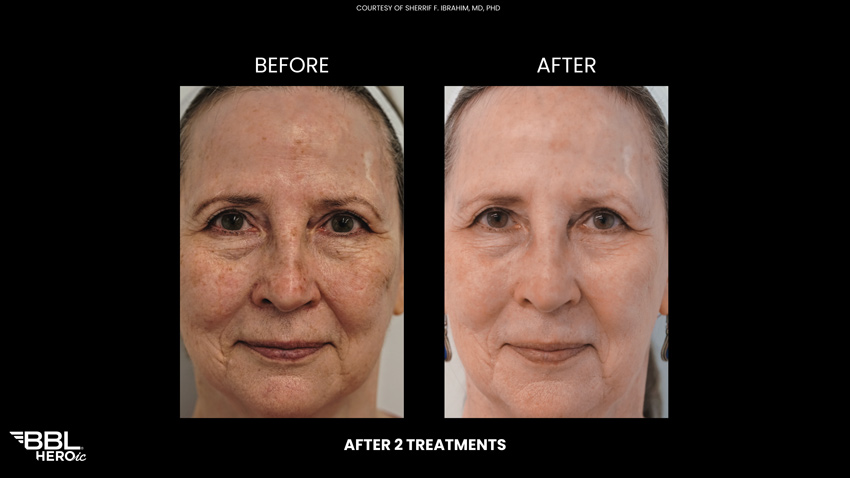 BBL Heroic - Before and After 2 treatments