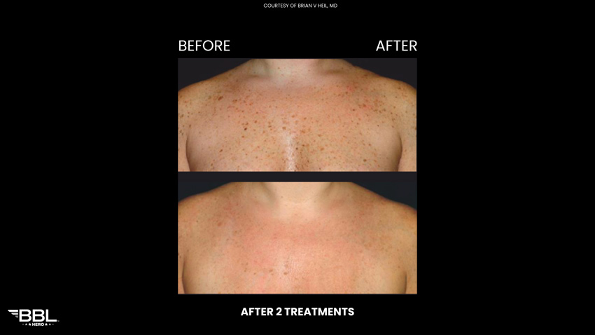 BBL Heroic - Before and After 2 treatments