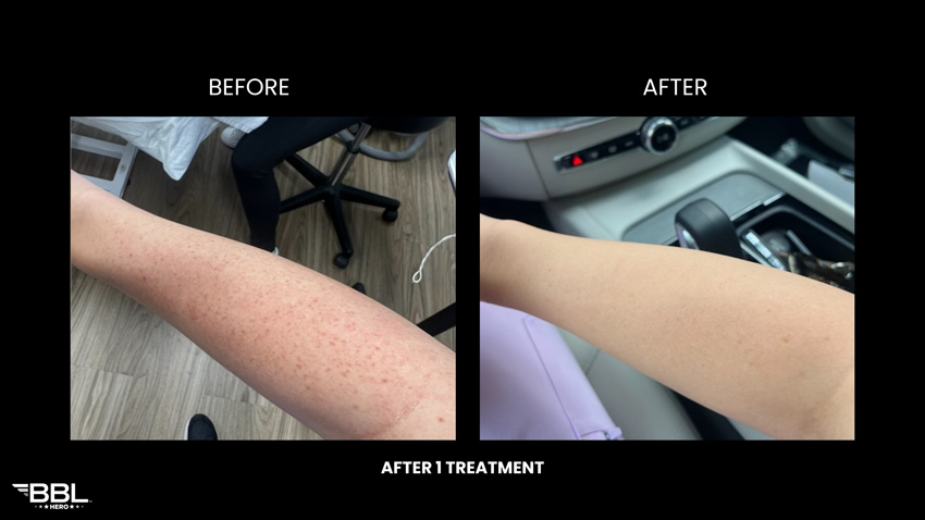 BBL Heroic - Before and After 1 treatment