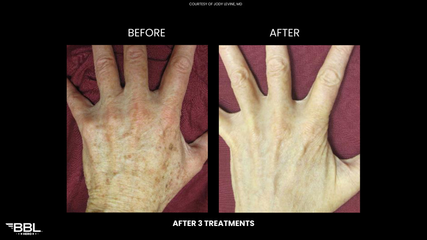 BBL Heroic - Before and After 3 treatments