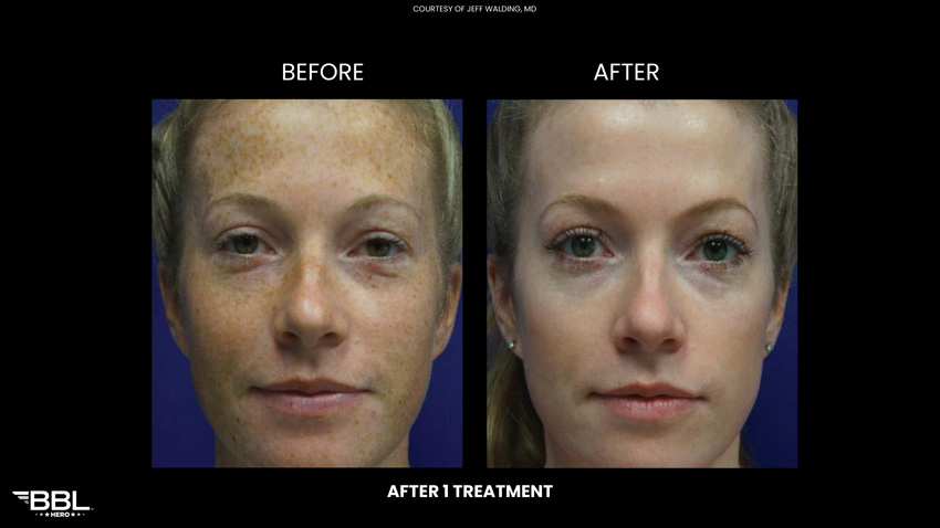 BBL Heroic - Before and After 1 treatment