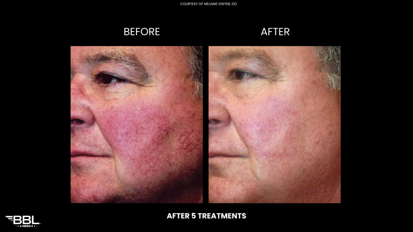 BBL Heroic - Before and After 5 treatments