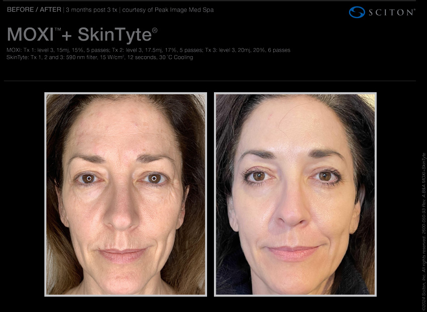 Moxi SkinTyte combo after 3 treatments