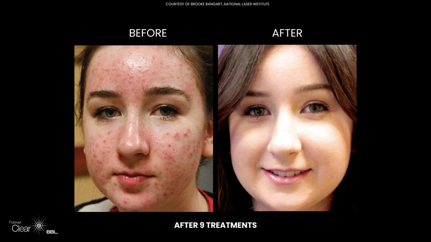 Forever Clear Before and After 9 treatments
