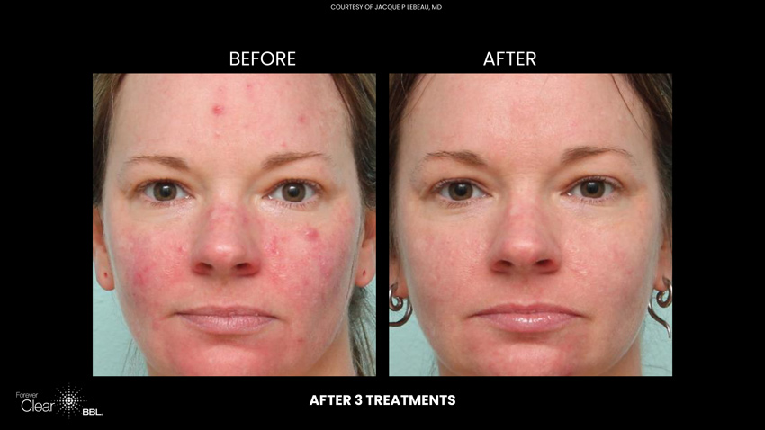 Forever Clear Before and After 3 treatments