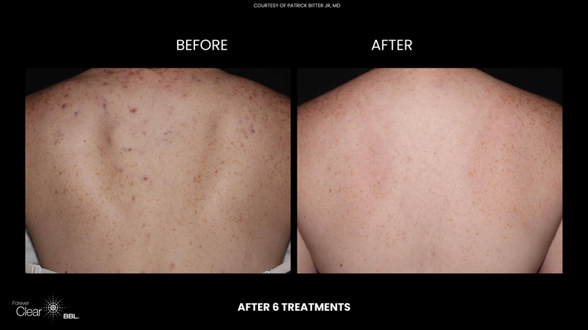 Forever Clear Before and After 6 treatments