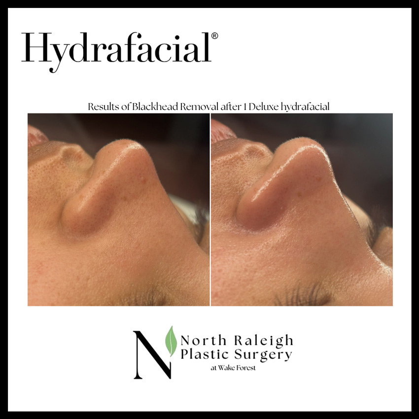 Hydrafacial: Results of Blackhead Removal after one Deluxe hydrafcial.