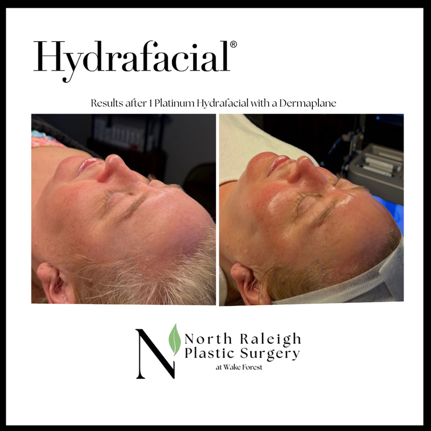 Hydrafacial: Results after one Plastinum Hydrafacial with a Dermaplane