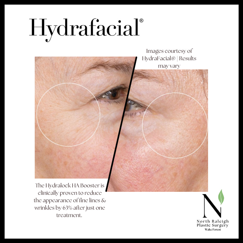 Hydrafacial: The Hydralock HA Booster is clinically proven to reduce the appearance of fine lines and wrinkles by 63% after just one treatment.