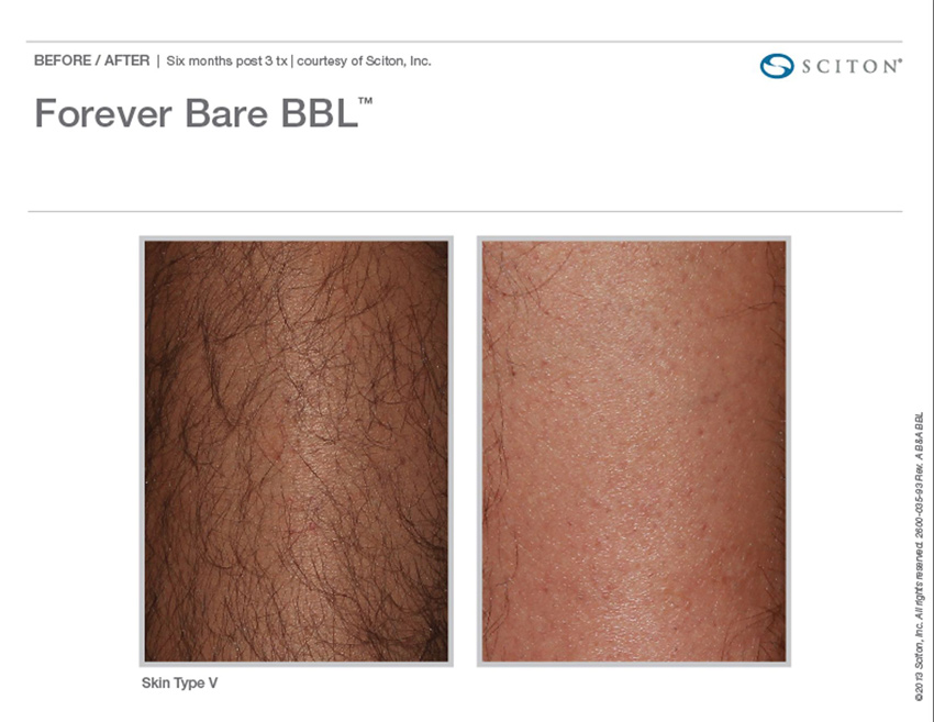 Forever Bare BBL Laser hair removal Before and After