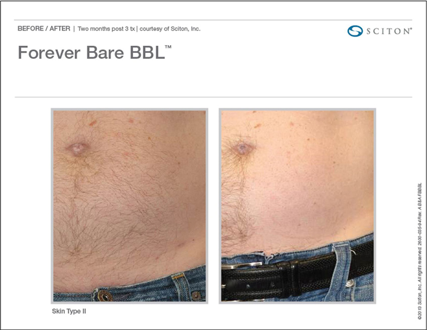 Forever Bare BBL Laser hair removal Before and After