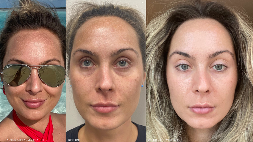 Moxi: Before and After