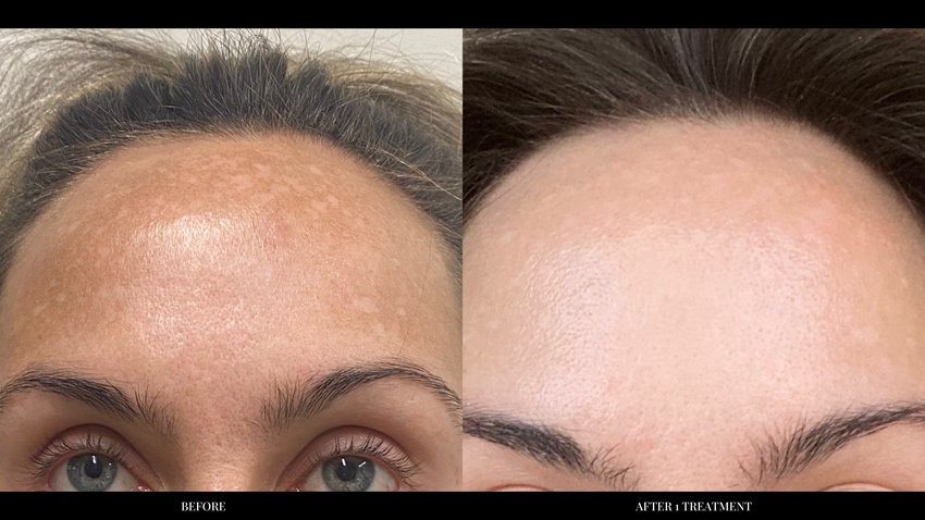 Moxi: Before and After 1 treatment