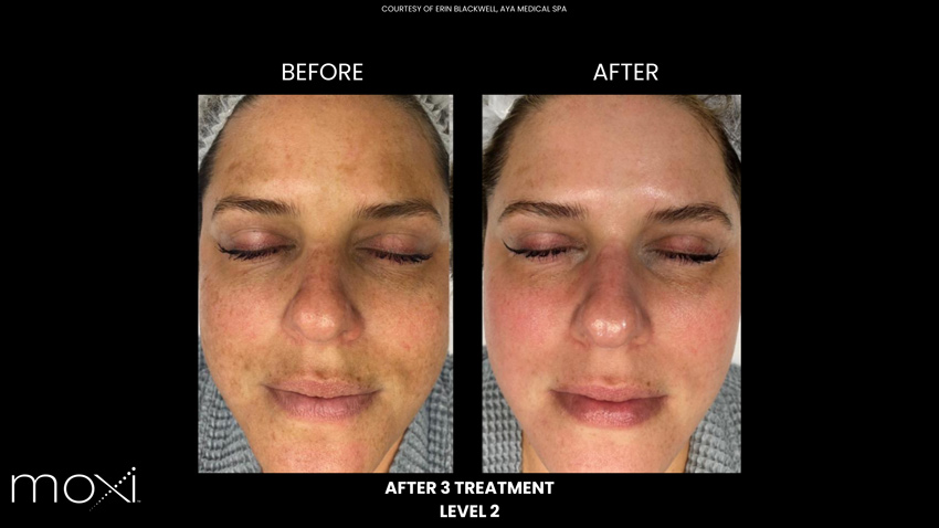 Moxi: Before and After 3 treatments