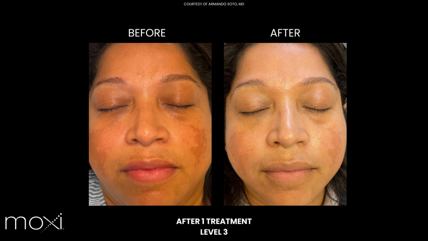 Moxi: Before and After 3 treatments