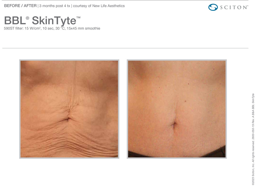 Skintyte before and after