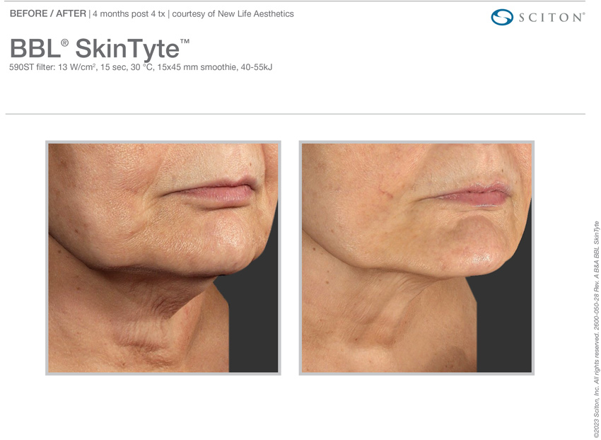 Skintyte before and after