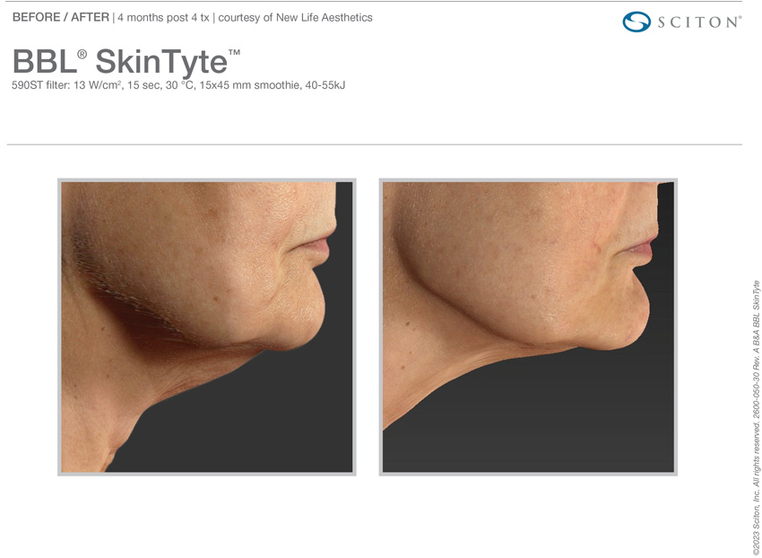 Skintyte before and after