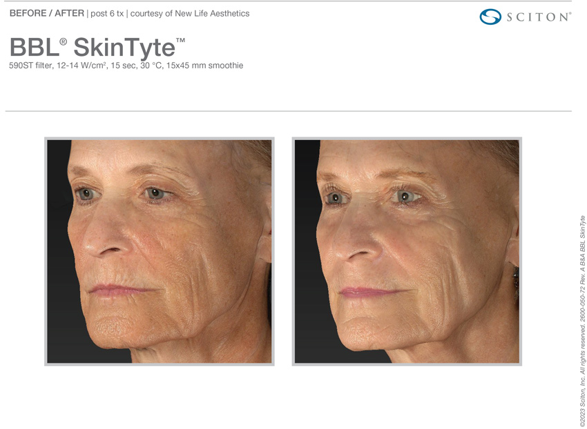 Skintyte before and after