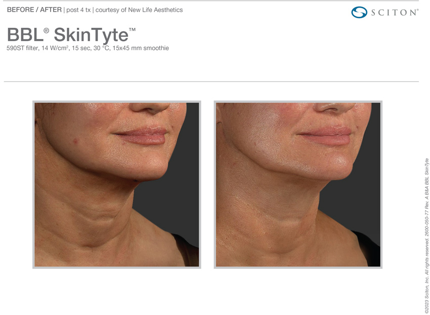 Skintyte before and after