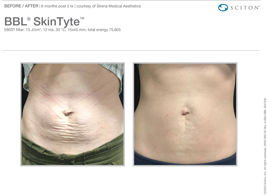 Skintyte before and after