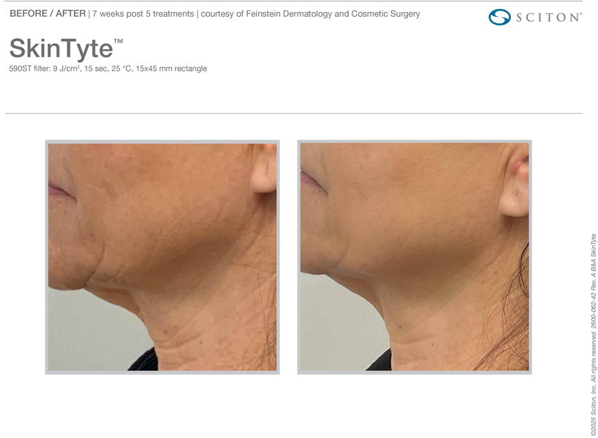 Skintyte before and after