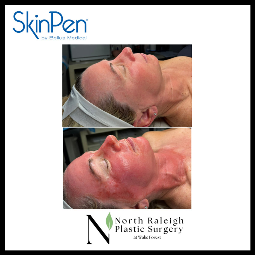 Skinpen microneedling before and after